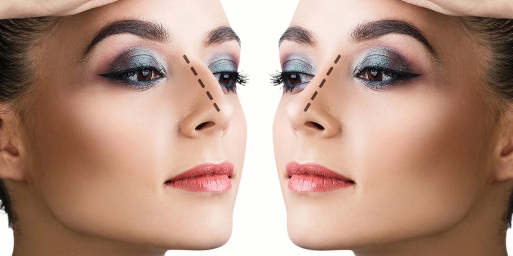 Ринопластика для разных типов носа: особенности коррекции широкого, курносого и азиатского носа