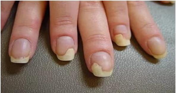 8 советов если сильно слоятся ногти экспертный материал