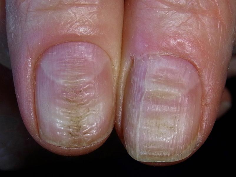 Deformacja paznokci