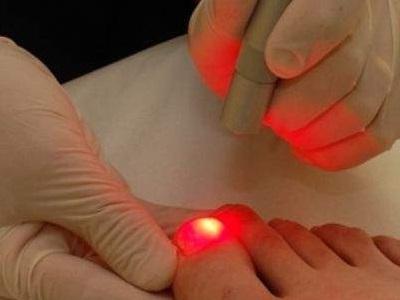 Лазерная коррекция вросшего ногтя